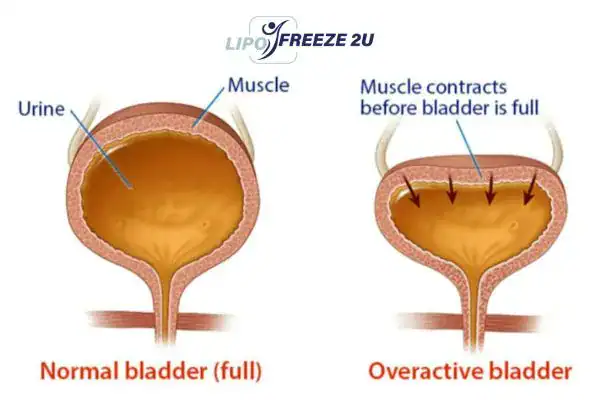 diagram of overactive bladder treatment Stowmarket