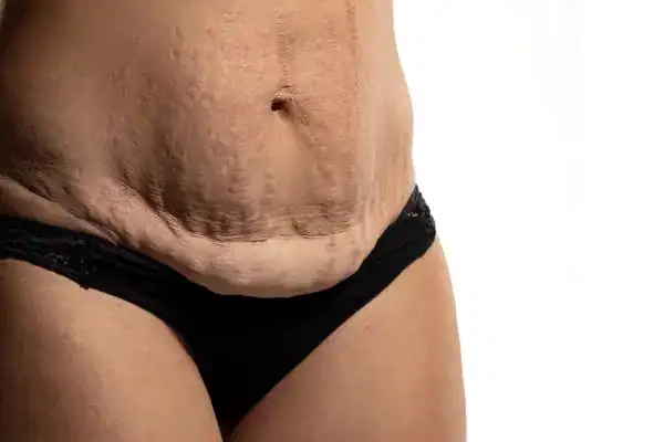 loose skin after weight loss injections Stowmarket
