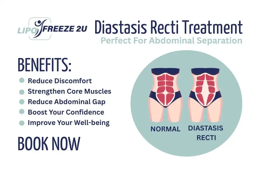 How Long Will It Take to See Improvements in Diastasis Recti Stowmarket