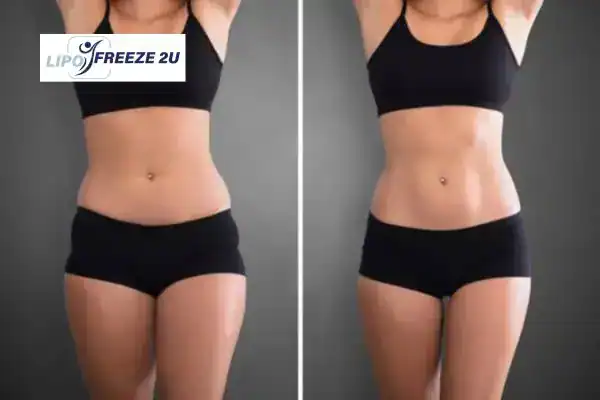How Can LIPO FREEZE 2U Support Your Post-Pregnancy Body Recovery Stowmarket?