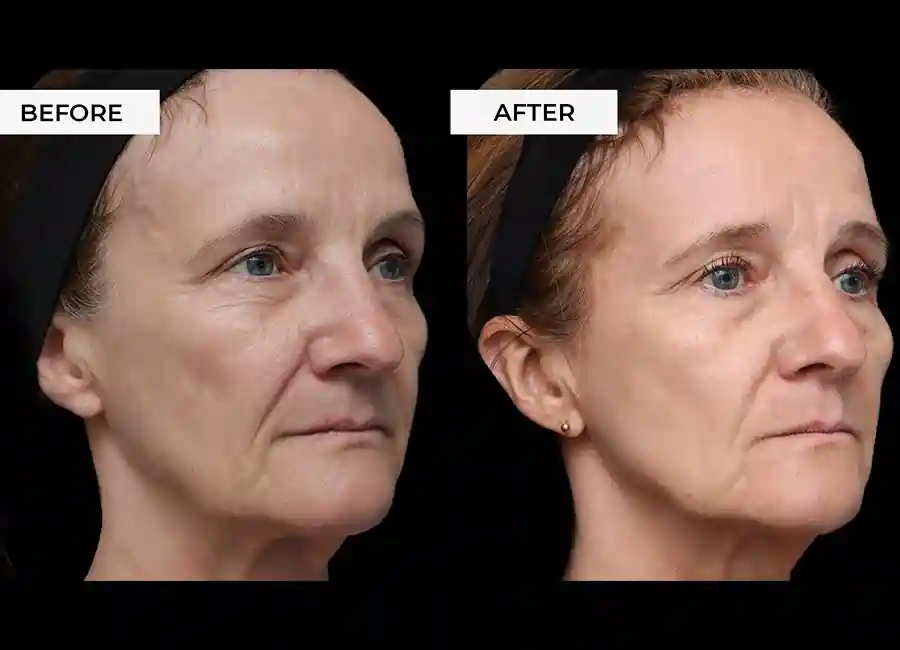How Many RF Microneedling Sessions Will You Need to See a Difference Stowmarket?