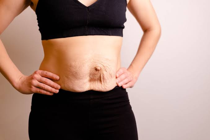 Is Surgery Really the Only Way to Repair Diastasis Recti Stowmarket?