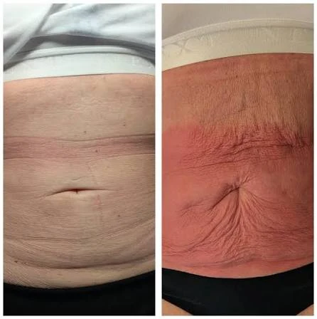 How Does RF Microneedling Improve Crepey, Thin and Uneven Skin Texture Stowmarket?
