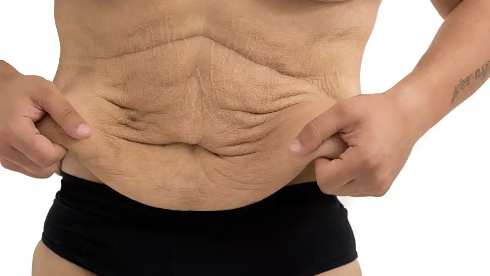 Why Does Weight Loss Medication Leave Some People With Loose or Sagging Skin Stowmarket?